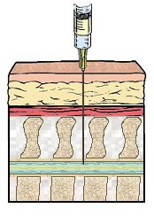 IV needle